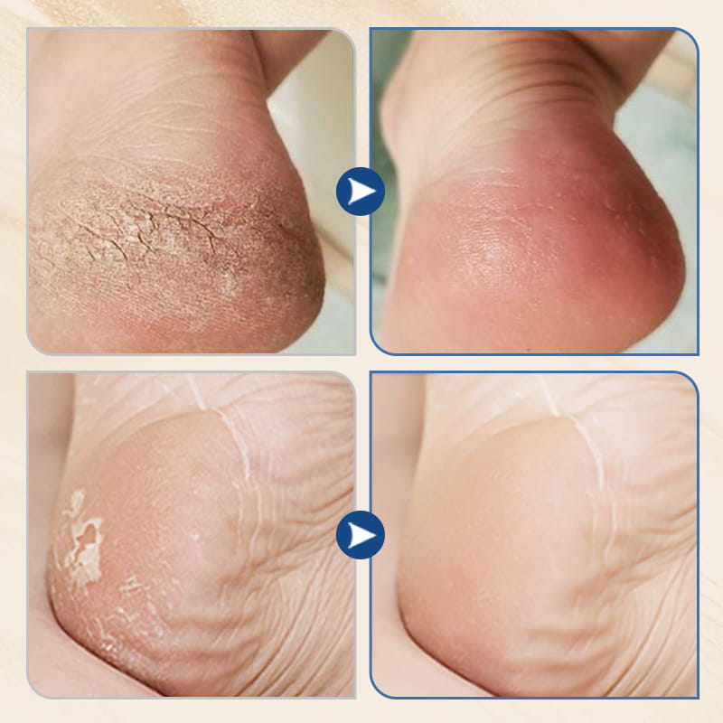 ⏳Time-Limited Special⏰Hydrating & Anti-Cracking Foot Cream – Intensive Moisture, Repairs Dry & Cracked Heels, Softens Rough Skin ✨